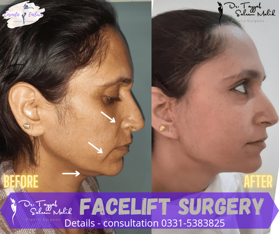 facelift Surgery