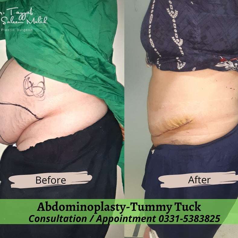 Abdominoplasty- Tummy Tuck