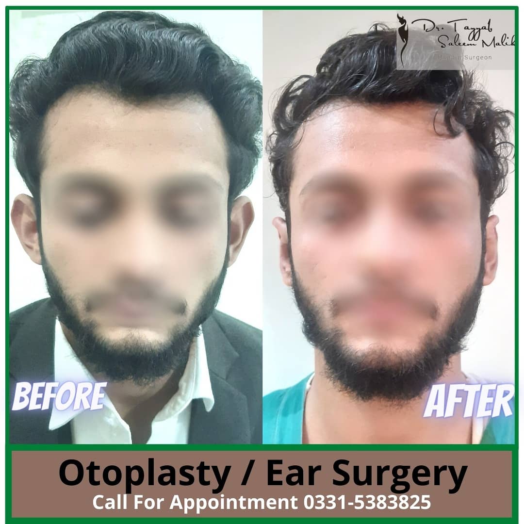 Otoplasty (prominent ear)