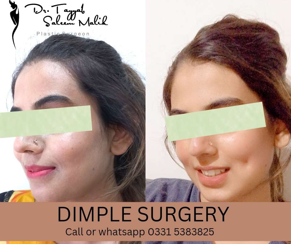 Dimple Surgery