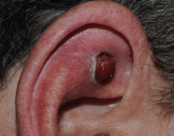Ear tumors