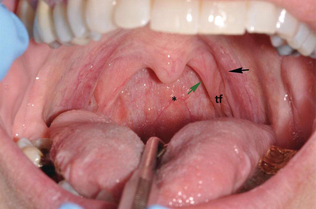 Oral cavity Mandible