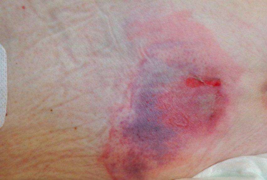 Pressure ulcers / bed sores