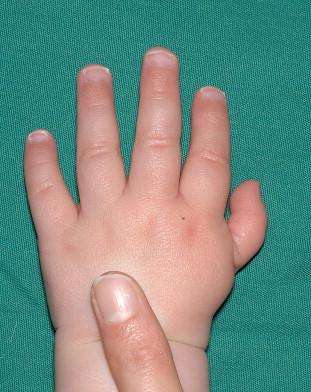 Thumb hypoplasia
