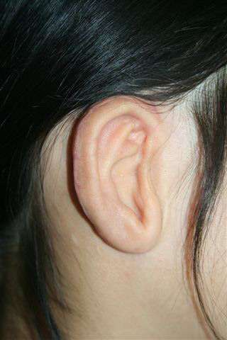 Microtia (ear reconstruction)